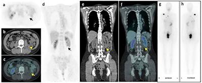 Renal cell oncocytoma tumor evolutions: a case report